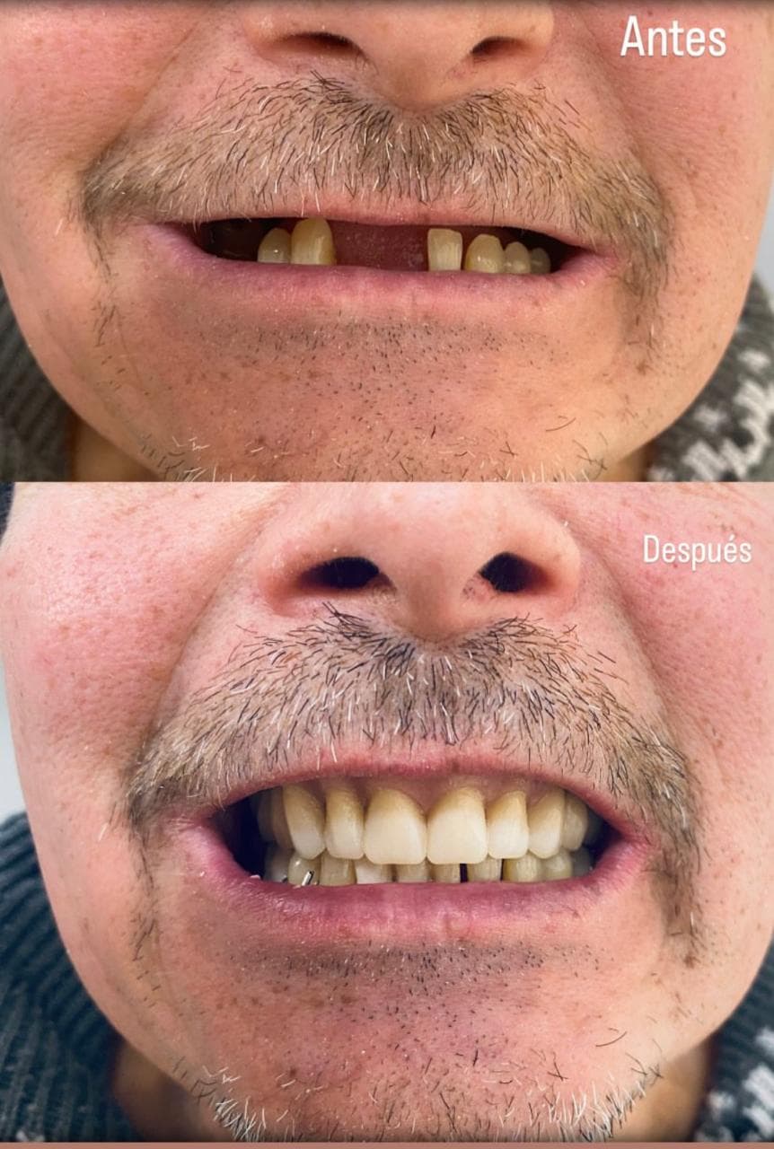 Caso de restauracion dental - Antes y Despues